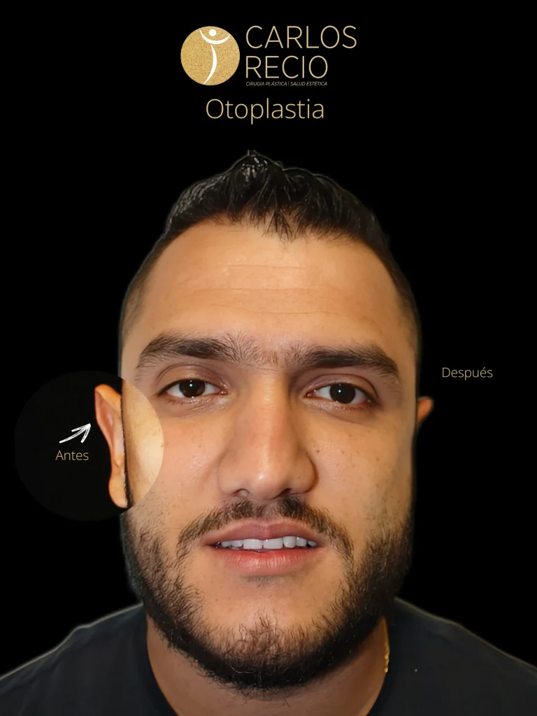 Otoplastia la cirugía que corrige y armoniza tus orejas Otoplastia la cirugía que corrige y armoniza tus orejas